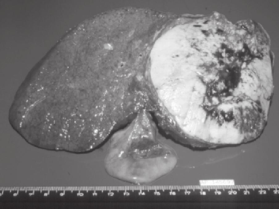 Revista HCPA 2002;22 (3) NEO-ADJUVÂNCIA: OBJETIVOS Erradicar doenças microscópicas intra-hepáticas para aumentar a sobrevida através do emprego de quimioterapia local e/ou sistêmica.