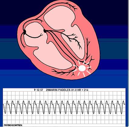 Taquicardia Ventricular sem pulso