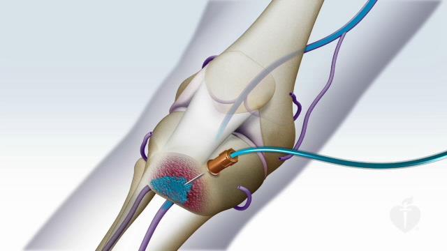 Intraósseo Endotraqueal Vias IV e IO são preferíveis à via endotraqueal Drogas utilizadas na PCR que podem ser administradas por