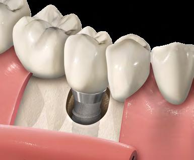 O tratamento cirúrgico envolve diferentes métodos de descontaminação, desbridamento com retalho, que pode ser combinado com a cirurgia