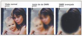 Luteína e saúde Doenças dos olhos: DMRI;