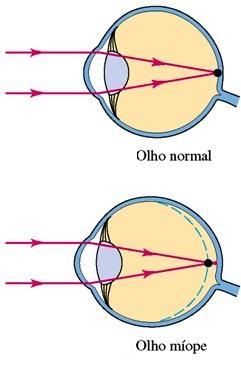convergirão para um ponto situado antes da retina. A vergência é excessiva em relação à distância da retina aocristalino.