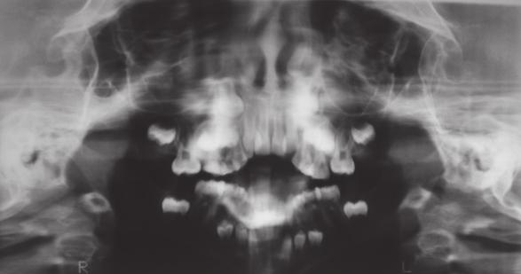 CONSIDERAÇÕES FINAIS Os respiradores bucais tendem a apresentar maior inclinação mandibular, padrão de crescimento vertical com alterações nas proporções faciais normais, caracterizadas pela maior