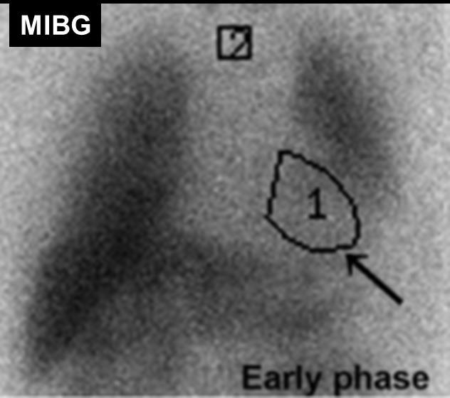 Parkinsonismo atípico: demência com corpos de Lewy Parkinsonismo