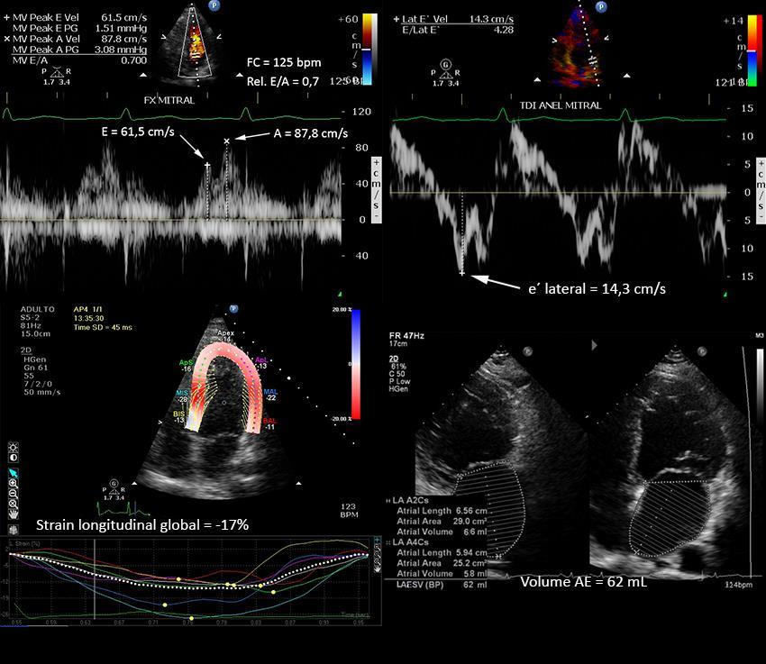 Caso 2. Adulto sedentário, assintomático, encaminhado para avaliação cardiológica de rotina. Solicitado teste ergométrico e ecocardiograma (Figura 12).