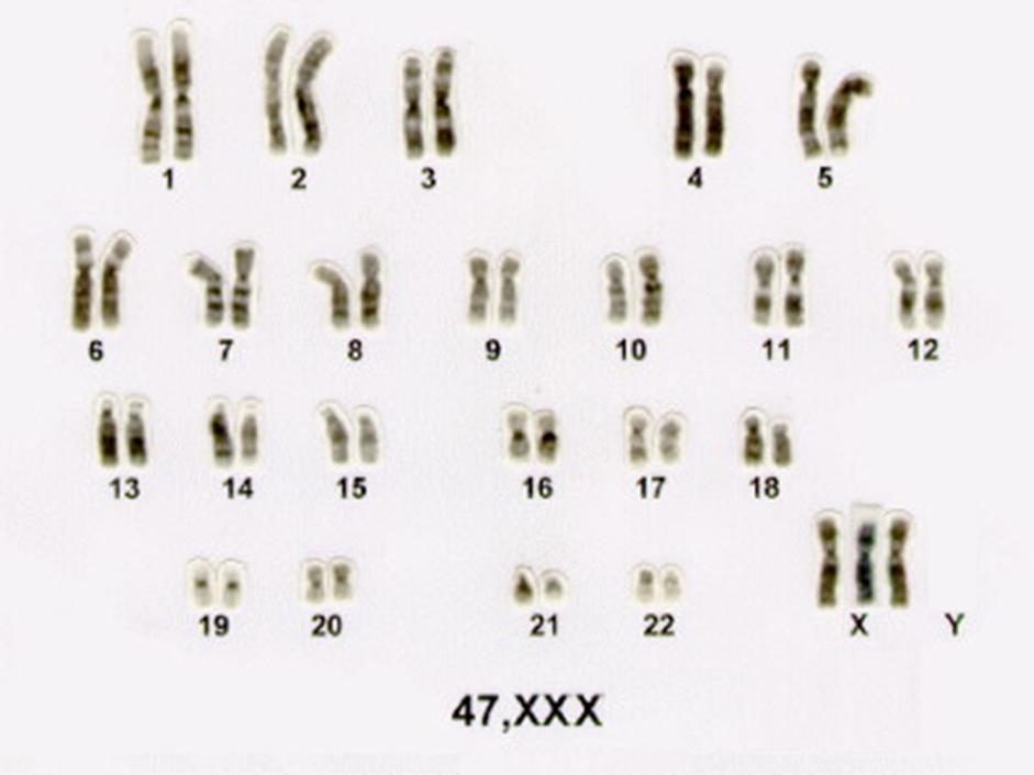 - Síndrome do triplo X (Trissomia do X): Na maioria das vezes o cariótipo é 47, XXX.