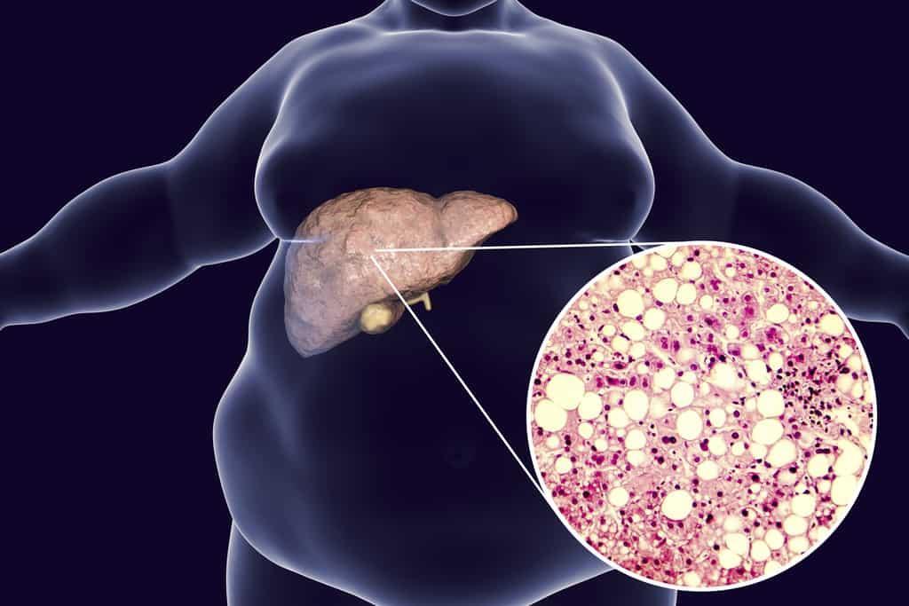 PREJUÍZOS AO FÍGADO O fígado é um dos órgãos mais afetados pela ingestão de álcool, pois ele é responsável por metabolizar o etanol ficando propenso a danos e doenças como a