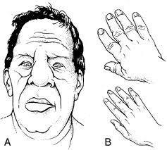 Figura 2. Alterações faciais e de extremidades comuns nos pacientes portadores de acromegalia.