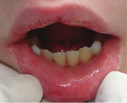 Masticatory system in JDM patients TABLE 1 Global orofacial evaluation in JDM patients and controls Variables Reference values JDM (n = 26) Controls (n = 22) P-value Demographic data Current age,