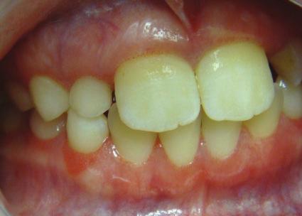 307** Orofacial clinical features Gingival vasculopathy pattern, n (%) 16 (61) 0 (0) 0.0001** Oral mucosa telangiectasia, n (%) 6 (23) 0 (0) 0.023** Orofacial complaints, n (%) 5 (19) 0 (0) 0.