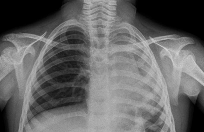 sob visualização direta para diagnóstico e sendo também utilizado como terapêutica na retirada de CE e auxiliando na redução da mortalidade e do tempo de internação hospitalar (WAKSMAN et al, 2005;