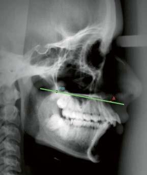 gomaxilar cruzando com a imagem da linha biespinal) e o ponto A na maxila. Linha NA, linha NB e linha AB (Figura 1). Figura 1 Ilustração do plano PmA com a localização do ponto Pm.