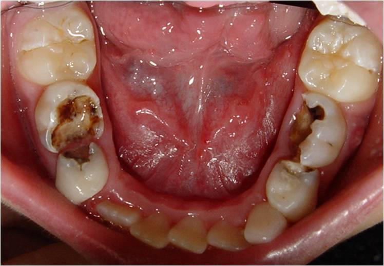 26 Figura 2 Aspecto clínico de lesão de cárie extensa em dentes decíduos (elementos 75 e 85) Fonte: Adaptado de FO-USP (2011) Figura 3