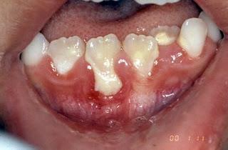 28 Figura 4 Aspecto clínico de periodontite em grupo de dentes decíduos anteriores inferiores Fonte: Adaptado de FOB-USP (2011) Apesar das evidências epidemiológicas apontarem que a maioria das