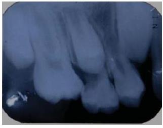 30 Figura 6 Radiografia periapical: erupção ectópica do elemento 16 e reabsorção radicular do elemento 55 Fonte: Adaptado de Gonçalves et al.