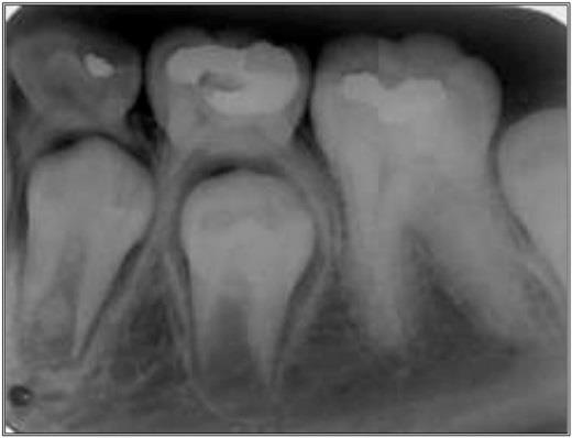 alveolar, com consequente obliteração do ligamento periodontal em determinadas áreas em torno da superfície radicular. As implicações referentes à anquilose, para Alves et al. (2011, p.