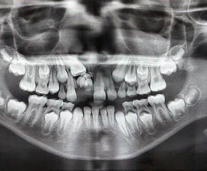 35 Figura 11 Radiografia panorâmica: evidenciando odontoma composto na região dos incisivos superiores Fonte: Cortesia do Dr. Alex Ramos (2016) Segundo Pires et al. (2013, p.