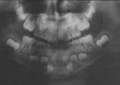 36 que esta situação não irá ser corrigida naturalmente, tendo como principal consequência o apinhamento dentário severo.