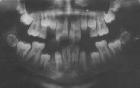 após exodontia dos caninos decíduos; (C) após exodontia dos primeiros pré-molares (D) final da extração seriada Fonte: Cortesia de Henrique Pretti UFMG (2015)