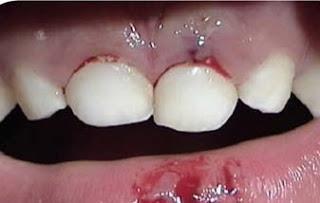 40 Figura 14 Aspecto clínico de luxação extrusiva no dente 61 Fonte: Adaptado de Guedes-Pinto (2010) A exodontia está indicada como tratamento de escolha em casos de extrusões severas, superiores a 3