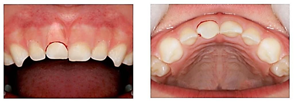 41 Figura 16 Aspecto clínico de luxação lateral no elemento 51 Fonte: Adaptado de SEOP (2010) Quando ocorre um deslocamento severo do dente decíduo para vestivular, em que existe a colisão de grande