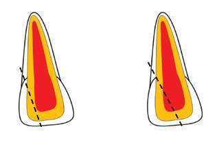 quando se expõe a polpa, pode-se observar a hemorragia ou pontos vermelhos indicativo do envolvimento pulpar (Figura 22).