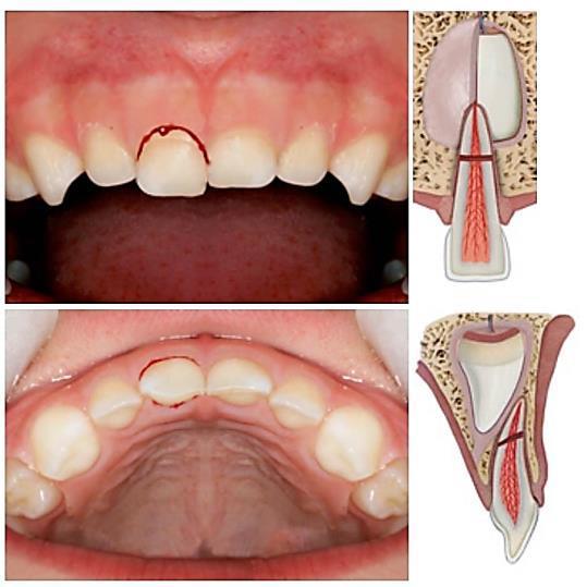 46 Figura 23 Aspecto clínico e desenho esquemático de fratura radicular (plano vestibular e oclusal, respectivamente), (elemento 51) Fonte: Adaptado de SEOP (2010) Figura 24 Radiografia periapical