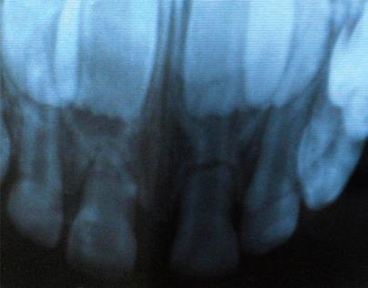 (2011) Independentemente do tipo de lesão, em tecido dentário ou periodontal, a exodontia deverá ser empregada avaliando-se alguns critérios, no que concerne a procura imediata ou tardia pelo