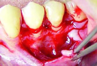 Ou seja, podemos definir estética em Medicina Dentária como sendo uma harmonia entre tecidos duros (coroas dentais naturais ou artificiais) e tecido gengival circundante.