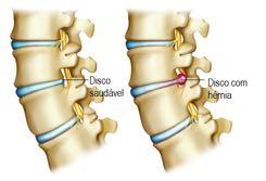 Hérnia De Disco Ocorre quando parte de um disco intervertebral sai de sua posição normal e