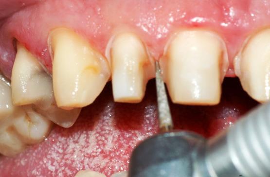 Nesse momento também, selecionou-se a cor das facetas, com o uso da escala de cor Vita da Ivoclar, definiu-se pela cor B1 no terço médio e incisal e B2 no terço cervical, sendo confirmado em fases