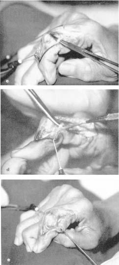 2c), envolve-se a banda ipsola- teral do tendão flexor superificial (fig. 1c), podendo ser testada sua eficiência na extensão da articulação interfalângica distal (fig. 2d).