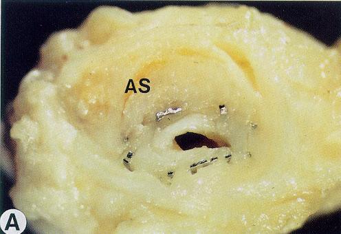 htm) A reestenose, definida como perda luminal de 5% pode ocorrer nas bordas proximal, distal