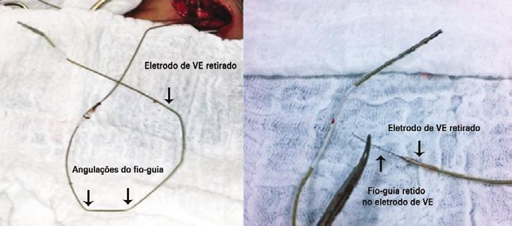 Vieira OG, Galvão Filho SS, Vasconcelos JTM, Melgar MA, Papelbaum B, Duarte CE Figura 3: Estratégias usadas nos pacientes com fio-guia retido.