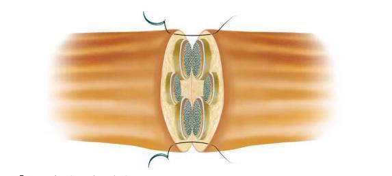 Uma delas é a sutura terminolateral do nervo lesionado, que consiste basicamente em suturar um nervo seccionado em um nervo saudável vizinho para a indução de um brotamento axonal, porém, os