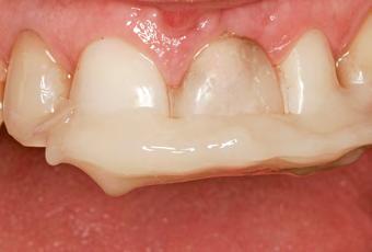 esmalte dos dentes vizinhos e do dente extraído é condicionada, o dente colocado no lugar com o auxílio do guia incisal e fixado nas proximais com resina composta flow (p.ex. Tetric Flow; veja Fig.