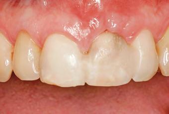 Figs 12-33 a 12-35 Terceira opção: o dente