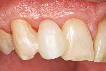 Prótese provisória Capítulo 12 C 207 Fig 12-36 O dente em resina foi fixado aos dentes vizinhos com resina composta flow.