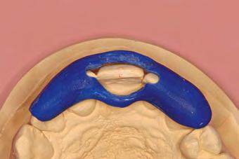 Fig 12-38 Registro intra-operatório: um guia de resina acrílica foi feito no modelo de estudo e preso aos dentes