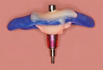 A retenção aparafusada é adequada primariamente para os implantes que foram instalados com propósitos
