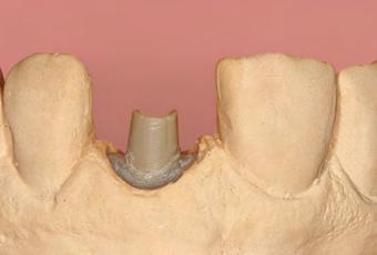 Prótese provisória Capítulo 12 C 209 Fig 12-46 A cavidade remanescente é preenchida com gesso na parte inferior. Fig 12-47 Transferência completa do implante.