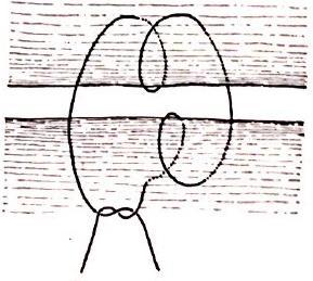 Ponto helicoidal Ponto em X, Z ou 8 horizontal; ponto cruzado ou de reforço linha de sutura. Desvantagem: Realização mais demorada com maior reação inflamatória.