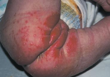 A dermatite irritativa das fraldas caracteriza-se pelo aparecimento de um eritema brilhante, semelhante a uma queimadura (Figura 3).