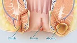 Patologia orificial Hemorroidectomia - ressecção das varizes hemorroidárias Fistulectomia - retirada de fístula