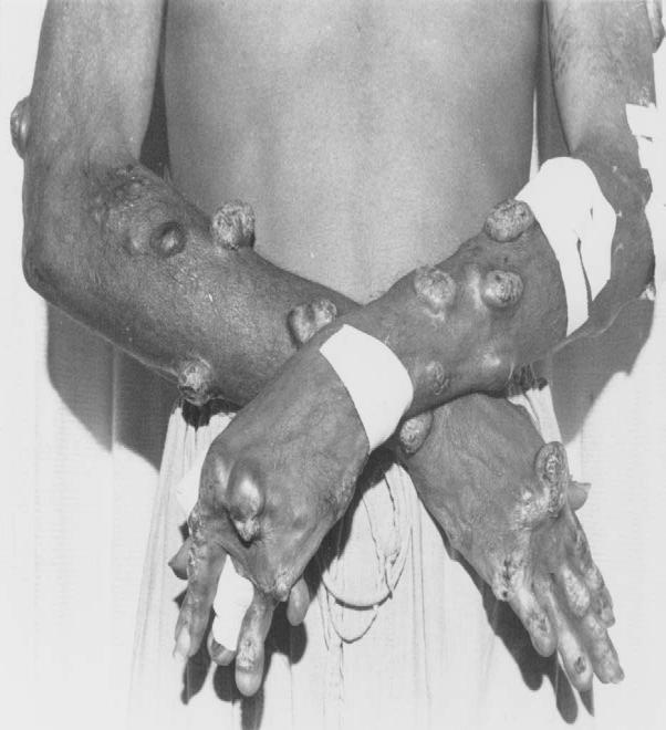 31 Figura 8 Paciente com alguns dedos da mão e do pé amputados, devido a LCAD Fonte: LAINSON; SHAW, 2005 4.6.