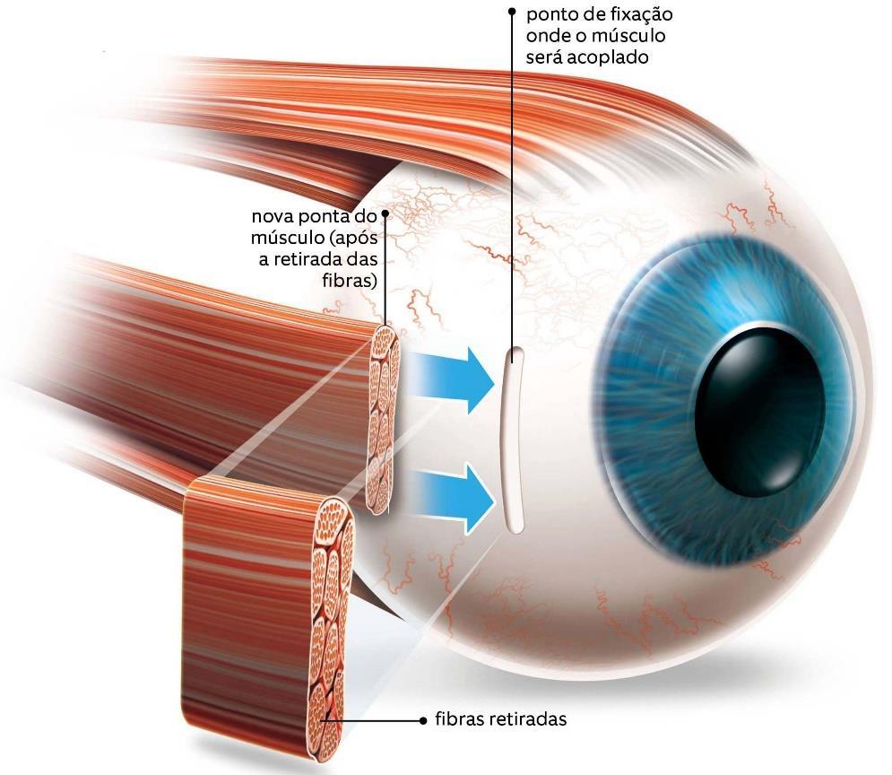 Numa delas, o músculo é desconectado do ponto em que se liga ao olho e recolocado mais pra trás, deixando-o
