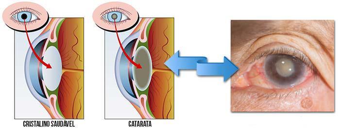 Catarata É uma opacificação do cristalino do olho que causa diminuição da capacidade visual. Pode afetar um ou ambos os olhos e é frequente desenvolver-se lentamente.