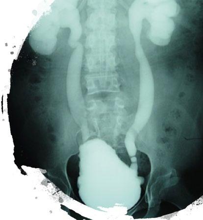 1. Aparelho urinário superior A insuficiência renal é o principal fator de mortalidade em pacientes com LVM, principalmente devido à alta pressão vesical Manter a pressão vesical baixa durante as