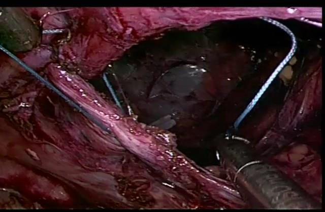 Fig.: 5 sutura do anel herniario.