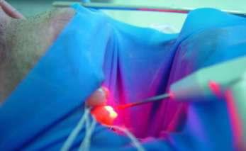 entretanto, pode ser desejável no caso da utilização de fibras ópticas, necessárias para a apropriada irradiação de, por exemplo, canais radiculares para que chegue luz suficiente no ápice dental.